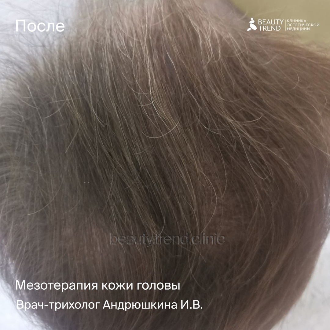 Мезотерапия для укрепления волос, 2А - после 1